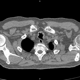 Cross sectional chest CT