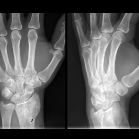 AP and oblique radiographs of the hand