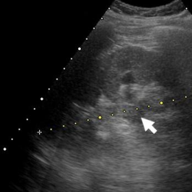 Emergency ultrasound of the urinary apparatus