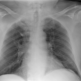 Chest radiography in PA