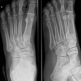 Anteroposterior and oblique radiograph of the left foot