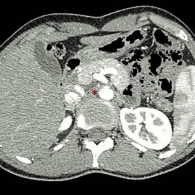 Aortic angio CT