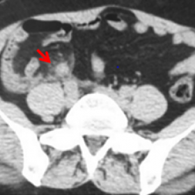 Axial enhanced CT at the level of the lower abdomen