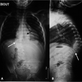 Frontal and lateral X-ray spine views