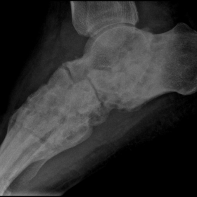 Lateral radiograph of the foot