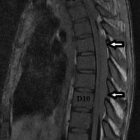 Spinal sagittal MRI