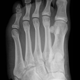 Oblique radiograph of the left foot