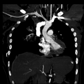 Coronal MDCT angiogram MIP image