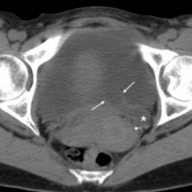 Unenhanced CT performed 2 years earlier