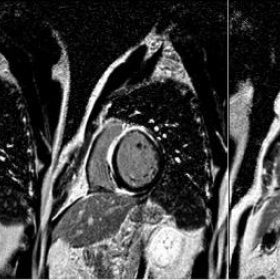 Cardiac MRI T1 post contrast myocardial delayed enhancement images