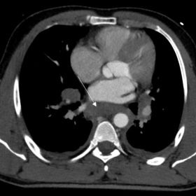 Thoracic CT
