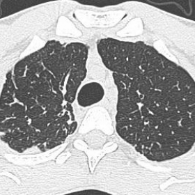 Axial CT images at diagnosis