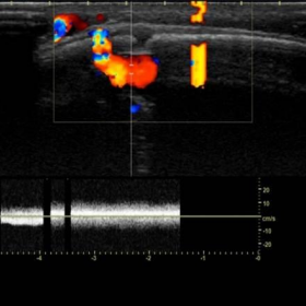 Colour Doppler transcranial ultrasound.