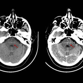Non-contrast and contrast-enhanced CT