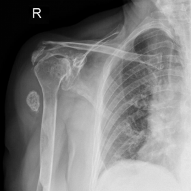 Antero-posterior radiograph of the right shoulder