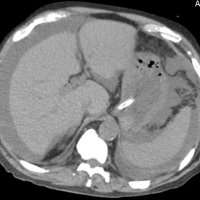 Unenhanced abdomino-pelvic CT