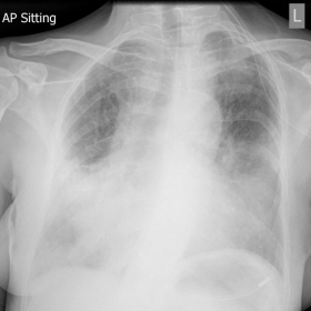Anteroposterior chest radiograph