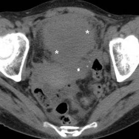 Initial unenhanced and post-contrast multidetector CT