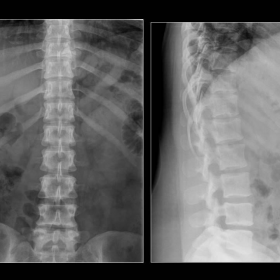 Dorsolumbar spine radiography