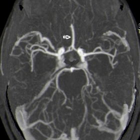 MDCT angiography