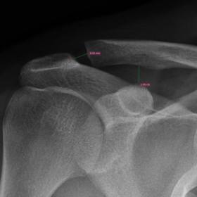 Acromio-clavicular joint injury