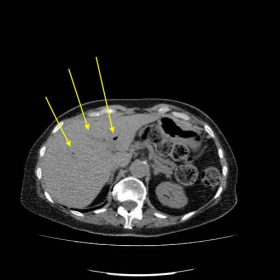 Non-contrast CT scan demonstrating gallstone ileus and associated pneumobilia