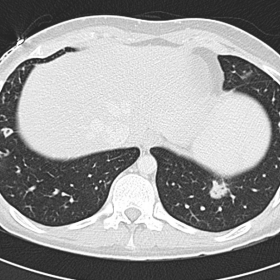 CT - Lung