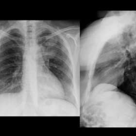 Frontal and lateral chest X-ray