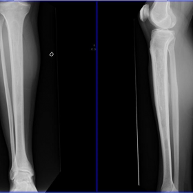 Film x-ray right leg AP/Lateral