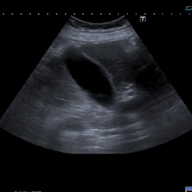 Abdominal Ultrasound (right upper quadrant)