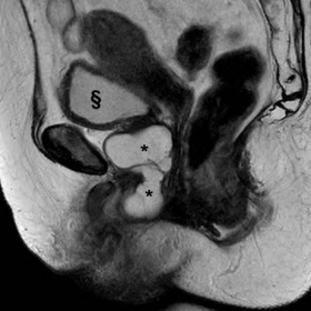 Pelvic MRI - unenhanced images