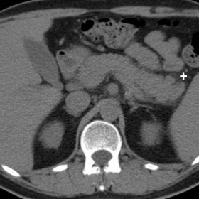 Initial (January 2015) unenhanced and post-contrast multidetector CT