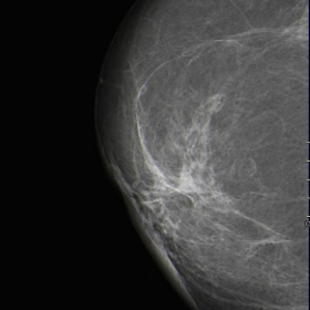Mammogram (2013)
