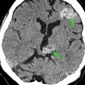 Non-enhanced brain CT scan