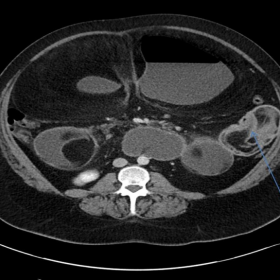 Axial CT abdomen demonstrating Intussusception at the proximal jejunum