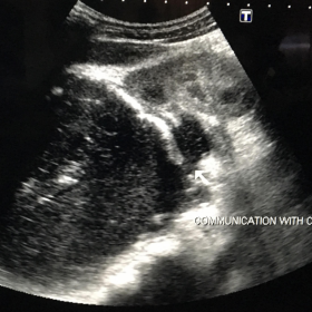 Ultrasound showing communication of cyst with calyces