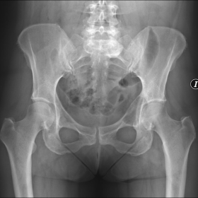 Pelvis with bilateral hip joints radiopraph: