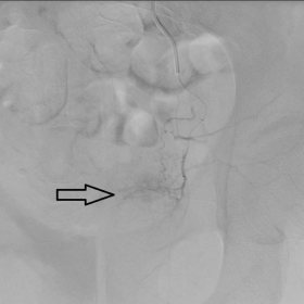 Superselective angiogram of the left prostatic artery after embolisation.