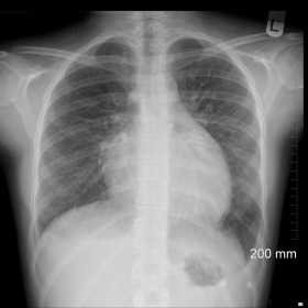 PA erect chest radiograph