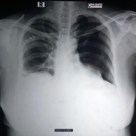 X-ray chest showing left pneumothorax