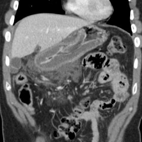 CT abdomen and pelvis with IV contrast