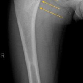 Conventional radiography of the right femur (AP projection)