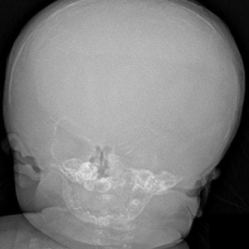 Post-mortem radiograph of the skull