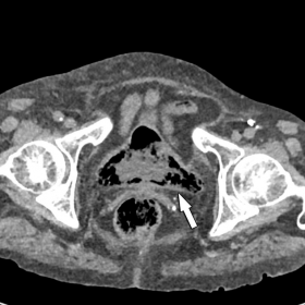Unenhanced abdominal CT