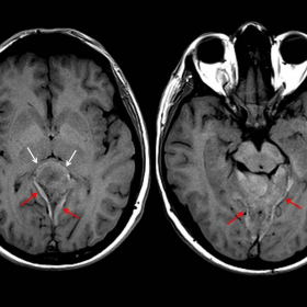 Brain MRI: Findings