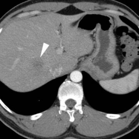 Initial multiphase contrast-enhanced CT