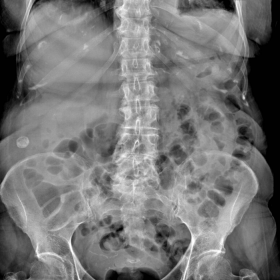 Plain abdominal radiography