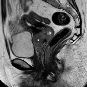 Initial pelvic MRI (limited noncontrast protocol because of claustrophobia)