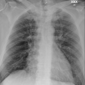 Supine X-ray