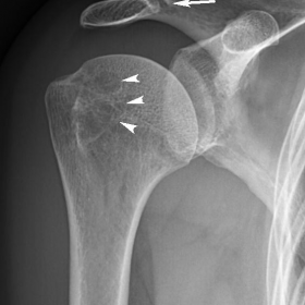 Anteroposterior plain radiography of the right shoulder